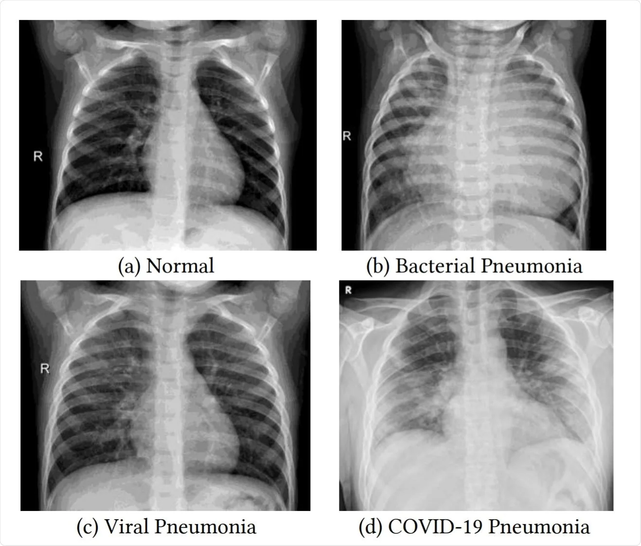 Screenshot of Respiratory Illnesses Classification in Lung X-Rays